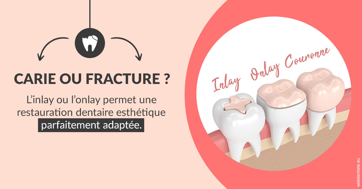 https://dr-strube-nicolas.chirurgiens-dentistes.fr/T2 2023 - Carie ou fracture 2