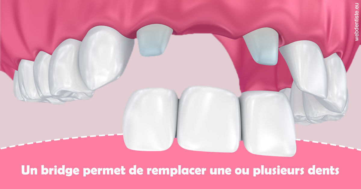 https://dr-strube-nicolas.chirurgiens-dentistes.fr/Bridge remplacer dents 2