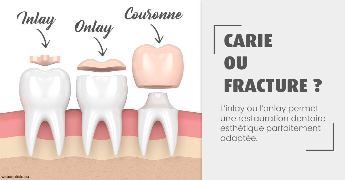 https://dr-strube-nicolas.chirurgiens-dentistes.fr/T2 2023 - Carie ou fracture 1