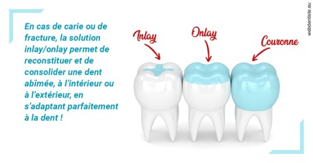 https://dr-strube-nicolas.chirurgiens-dentistes.fr/L'INLAY ou l'ONLAY
