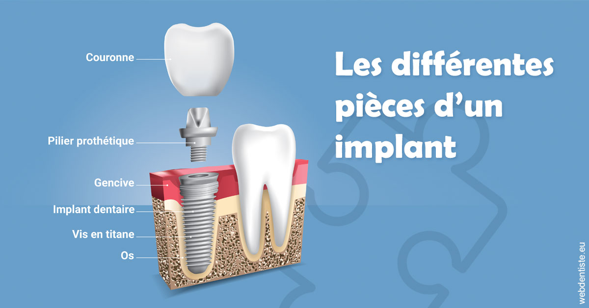 https://dr-strube-nicolas.chirurgiens-dentistes.fr/Les différentes pièces d’un implant 1